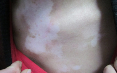 胸部白癜风两年了反反复复的长