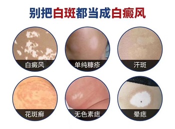 为什么长白斑怎么回事 白斑治的好吗
