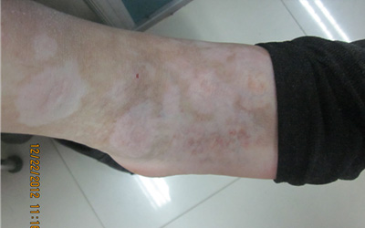 男性手背脚背有白斑怎么回事