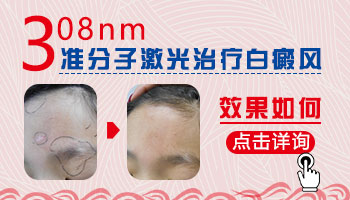 女性手上和脸上的白癜风ZUI近有发展