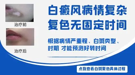 白癜风口服药需要吃多长时间一个疗程