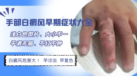 手指白斑早期症状图片