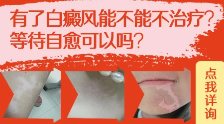 石家庄远大白斑医院能治好白癜风吗