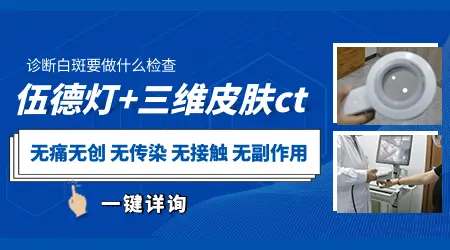 孩子脸上的白斑边界模糊是什么问题