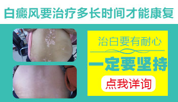 白癜风治疗周期是多久