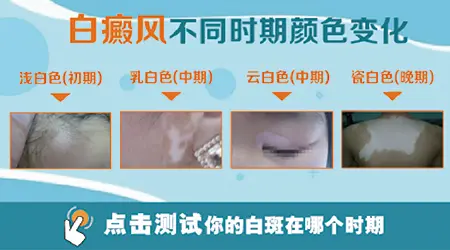 白癜风有哪些典型表现