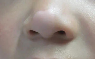鼻子白斑初期的图片