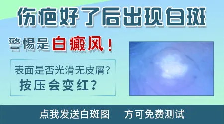 磕伤后留下的白斑有可能变成白癜风吗