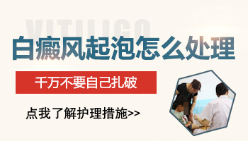 白癜风照308以后起泡了可以弄破吗