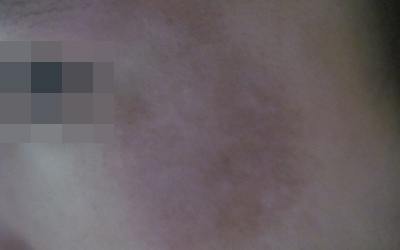 五岁宝宝脸上长了白点是不是白癜风