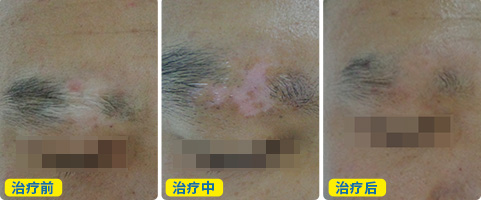 双手白癜风植皮手术后恢复图