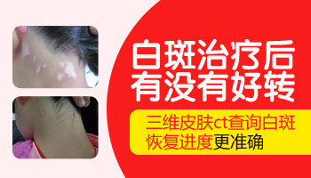 311照射白癜风好转现象