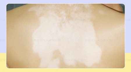 白癜风遗传吗 早期的时候有什么症状