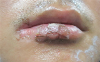 嘴唇上长白斑图片图库