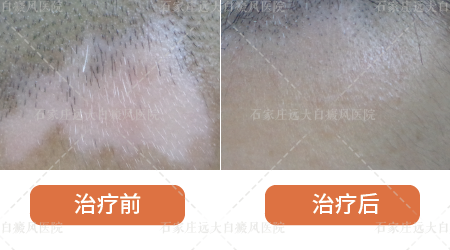 黑色素移植手术治疗白癜风的弊端
