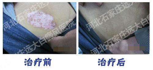 肚子两侧白癜风半年了怎么治