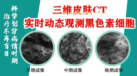 白斑做皮肤ct有什么用