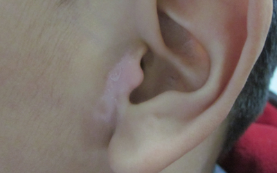 耳朵边和额头光滑的白点怎么回事