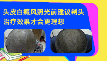 头皮里会有白癜风吗 头皮白斑怎么治