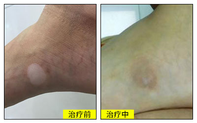 白癜风出现什么症状是在恢复