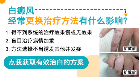 石家庄能治好白癜风吗