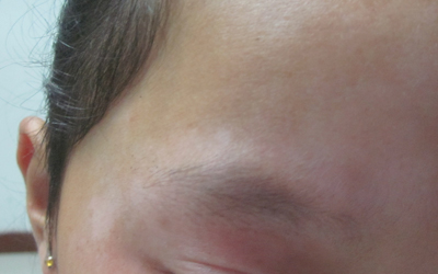 眉毛那突然白了一块是白癜风的前兆吗