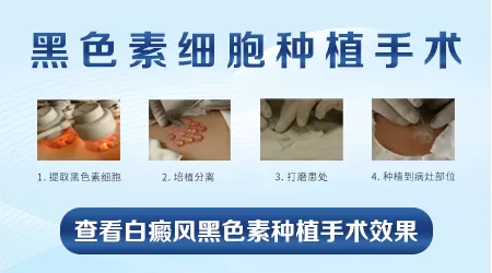 面部白癜风黑色素种植后效果图