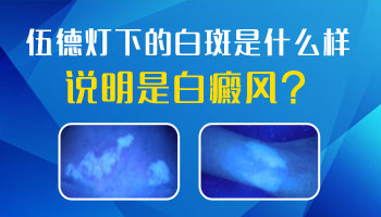 伍德灯下白斑亮蓝色荧光是不是白癜风