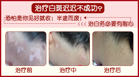 白癜风这个地方好了其他地方又长