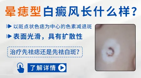 晕痣和普通白癜风有什么区别