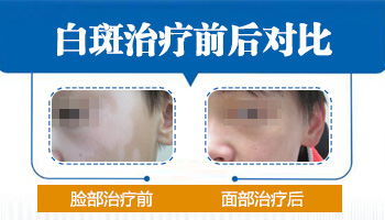 白癜风照光吃药报销吗