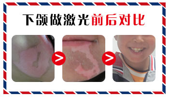 308激光治白斑治好了的图片