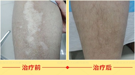 炎症后色素减退越来越白会不会是白癜风