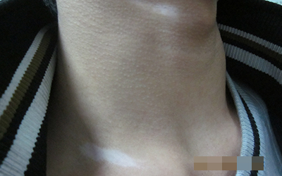 早期颈部白癜风的症状图片