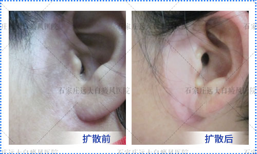 爷爷有白癜风会遗传给孙子吗