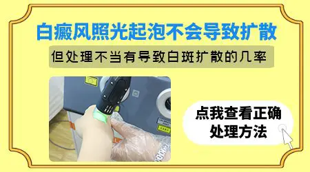 白癜风照激光出泡会加重病情吗