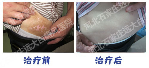 女士腰部白斑不痒不起皮是什么