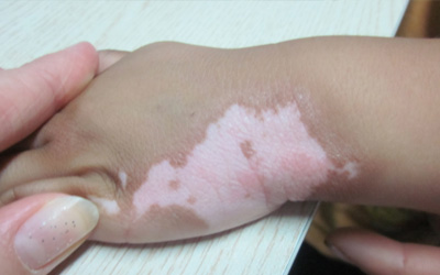 孩子身上有白点越来越大是什么