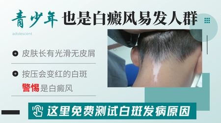 青少年肠胃不健康易发白癜风