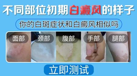 白癜风前期症状表现图片