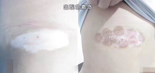 白癜风治疗后大概多久长黑色素