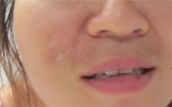 点痣的地方变白了是为什么