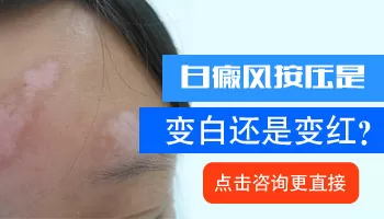 白癜风按压后是什么色