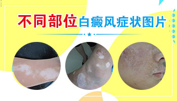 儿童初期面部白癜风的图片