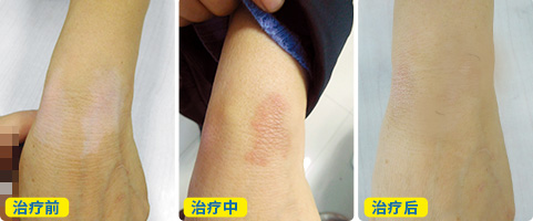 以前小白斑点ZUI近变大了