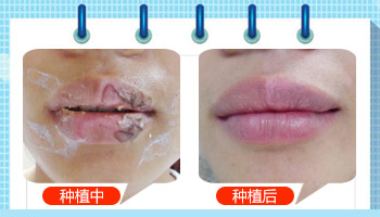 嘴唇边上有白斑治疗前和治疗后的对比图片