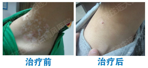 308激光治疗白癜风前后对比图片