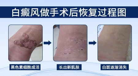肢端型白癜风初期能治愈