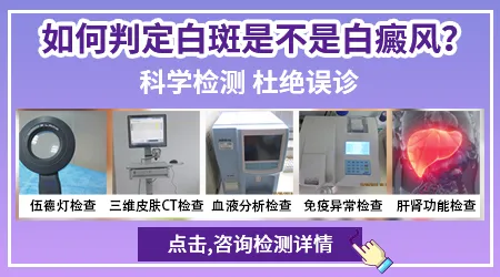 怎么判断自己身上的白是不是白癜风