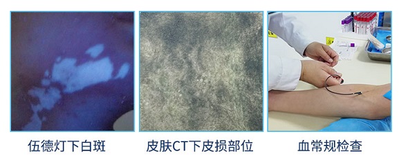 男童嘴角出现一块白斑怎么回事